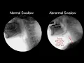 Normal vs Abnormal swallowing