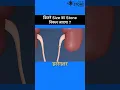 What size of kidney stone can pass naturally Animation