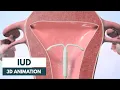 How does an IUD work 3D animation