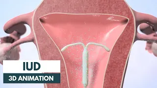 How does an IUD work 3D animation