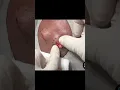 Download Lagu Double Trouble Pilar Cysts - watch them both in the video below! #drpimplepopper #popaholics