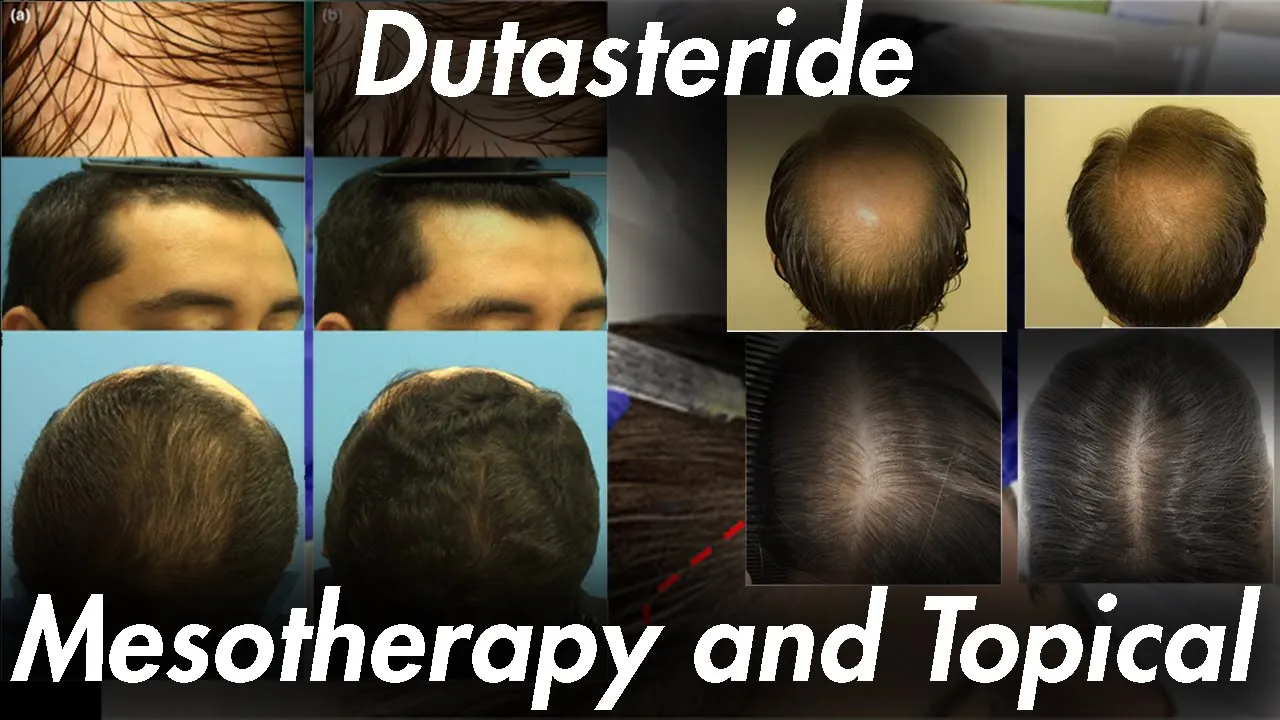 Dutasteride Topical and Mesotherapy: IT WORKS