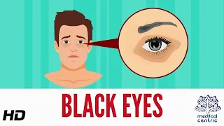 Black Eye Causes Signs And Symptoms Diagnosis And Treatment  Black Eye Causes Signs And Symptoms Diagnosis And Treatment