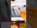 Download Lagu Another calcified tooth. #dentists #rootcanaltherapy #dentalprocedure #hygienist #dentist