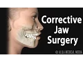 Corrective Jaw Orthognathic Surgery Animation