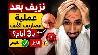  نزيف بعد عملية غضاريف الأنف ب   أيام  اعرف الطبيعي والخطر فور ا  دندنها
