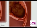 CERVICAL EFFACEMENT EXPLAINED