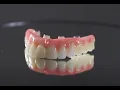 Full Mouth Dental Implants What You Should Know and Cost