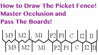 occlusion picket fence nbde part 1 boards study