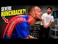 EXTREME HUNCHBACK GETS FLATTENED Asmr Chiropractic Neck Back Pain Dr Tubio