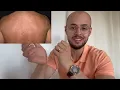 Comment soigner ce problème de peau ? 😰