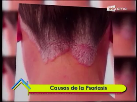 Causas de la Psoriasis