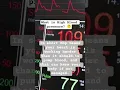 Download Lagu High Blood pressure explained in simple words #highbloodpressure #hypertension