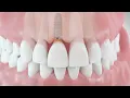 Lagu Dental Implant Procedure | Medical Animation