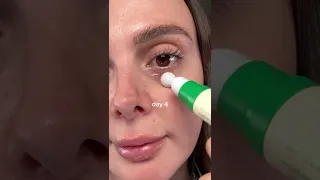 السيروم الكوري العجيب لعلاج الهالات السوداء حول العيون                         تجميل            دندنها