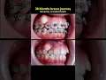 38 months braces journey From severely crooked teeth to perfect bite