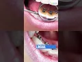 4 TYPES OF BRACES