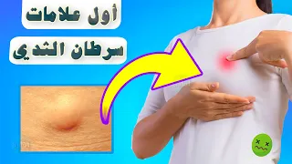 ماهي أول علامات سرطان الثدي ظهورا    دندنها