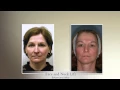 Face and Neck Lifts at Barr Plastic Surgery