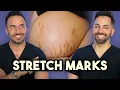 Major Announcement How to Treat Stretch Marks like a Dermatologist