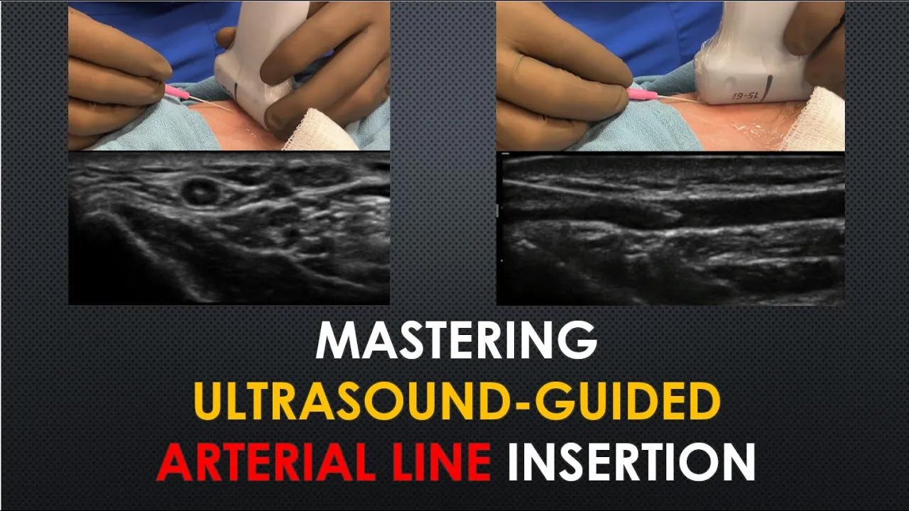 Mastering Ultrasound-Guided Arterial Lines [FULL version]