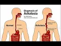 Discuss Esophaeal achalasia cardiac sphincter disorder Definition Causes Symptoms Diagnosis