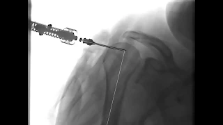 NIO Right Humerus Insertion 