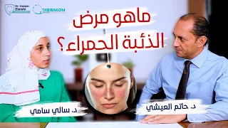 ما هو مرض الذئبة الحمراء مع د سالي سامي إستشاري الأمراض الروماتيزمية 