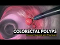 Colorectal Polyps Causes Signs and Symptoms Diagnosis and Treatment