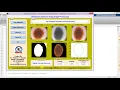 Melanoma Detection Using Matlab