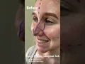 Download Lagu Nose Job Before \u0026 7 Days After | Crooked \u0026 Projected Nose