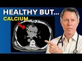 What I Tell my Patients with a Calcium Score Over 300