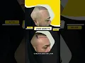 Download Lagu Hair Transplant in our patient. 2500 grafts | Care4Hair