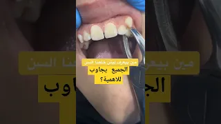خلع الاسنان بطريقة سريعة خلع الانياب طبيبة اسنان دكتور اسنان دكتورعبدالله سلطان Dentist Teeth 