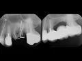Unique Multi-Unit Stress-Breaker Bridge - Dental Minute with Steven T Cutbirth DDS