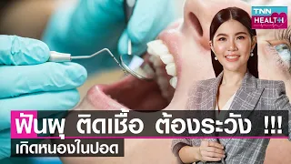 ภาวะการติดเชื้อในรากฟัน สามารถส่งผลให้เกิดหนองในช่องเยื่อหุ้มปอดได้อย่างไร