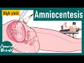 Amniocentesis Diagnostics Ultrasound Chorionic Villus Sampling Amniocentesis USMLE step 1