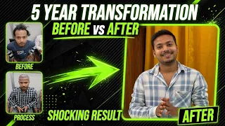 5 YEARS After Hair Transplant Shocking Result Before vs After FUE