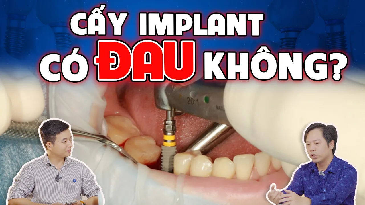 Outline Video Cấy Implant Có Đau Không? 5 Sự Thật Mà Các Bác Sĩ Nha Khoa Không Bao Giờ Tiết Lộ