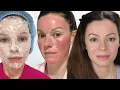 Would I Do CO2 Laser Again 8 Month Update Fractional