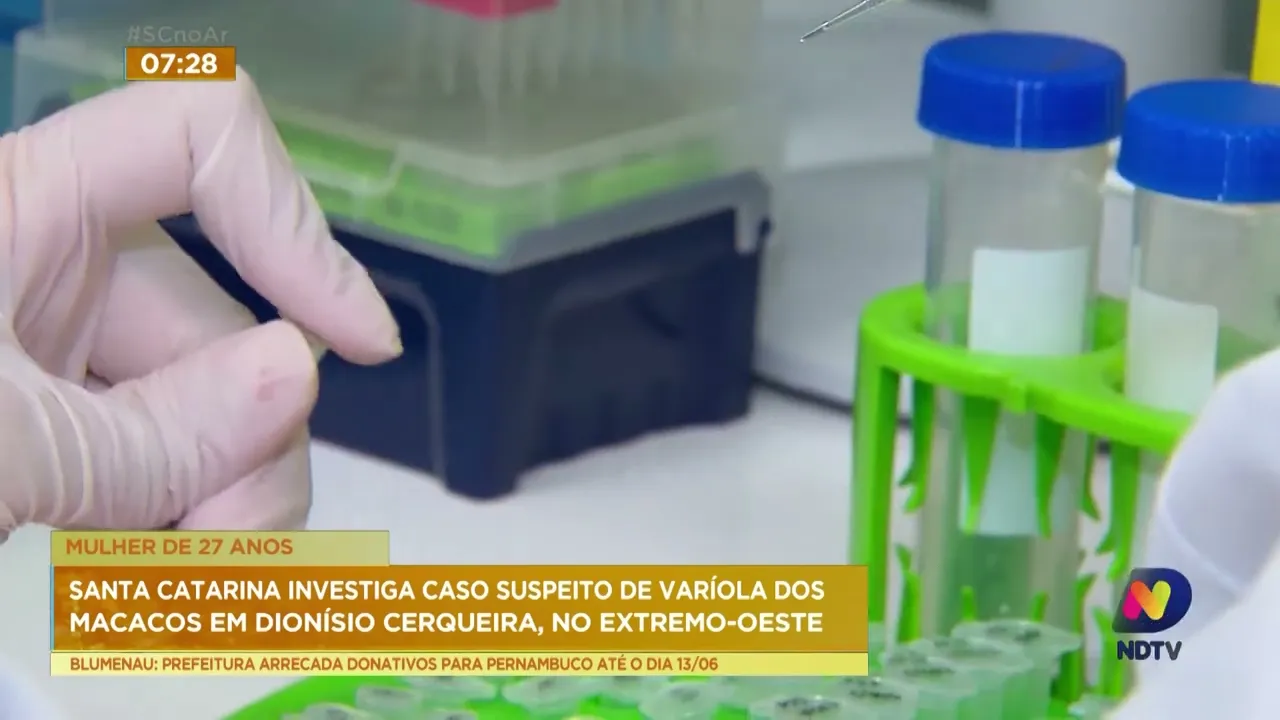 Santa Catarina investiga caso suspeito de Varíola dos Macacos