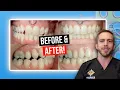 Missing Lateral Incisors w Braces BEFORE AFTER