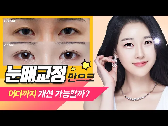 눈매교정만으로 어디까지 개선 가능할까? [JW 정원 Plastic Surgery]