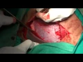 Download Lagu cesarean birth / C Section / LSCS/ Child Birth