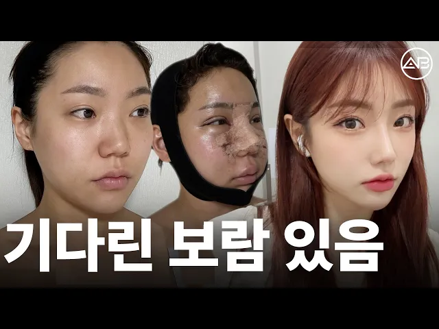 처음에 너무 부어서 성형 망한줄.. | 성형비포애프터 | 에이비성형외과