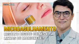 MICROAGULHAMENTO resolve Bigode Chinês e Linhas de Marionete? |Sua Dúvida Vira Vídeo #122