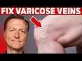 How to Treat Varicose Veins Naturally - Dr Berg