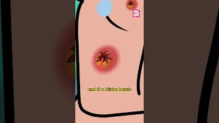 What Is Hand Foot And Mouth Disease Infant Protection Day Special Short Diseases Kids Infant 