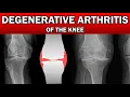 Degenerative Arthritis of the Knee on X-Ray