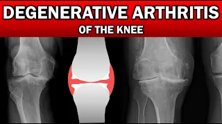 Degenerative Arthritis of the Knee on X-Ray